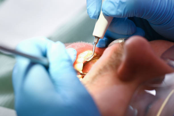 Best Emergency Dental Care for Sports Injuries in El Cerrito, CA